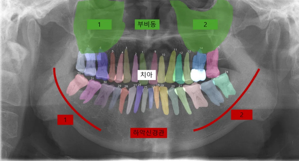 SAM Fine-tuning for Medical Imaging